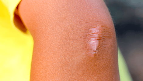 Image of scar tissue on an elbow. 